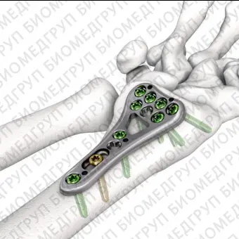 Компрессионная костная пластина лучевая кость LOQTEQ VA 2.5