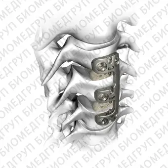 Шейная костная пластина для артродеза VERTEVIEW
