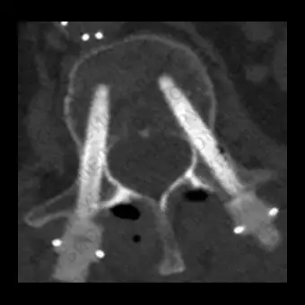 Система остеосинтеза для грудопоясничнокрестцовой зоны CarboClear