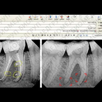 Программное обеспечение для обработки снимков зубов DEXIS