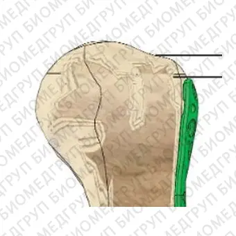 Компрессионная костная пластина плечевая кость P.R.C.T II