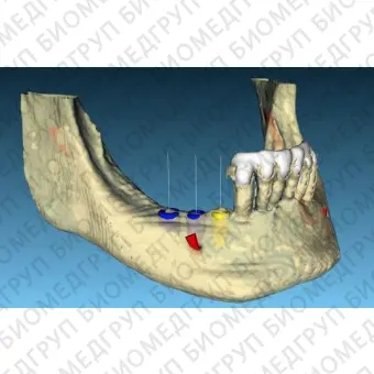 Программное обеспечение для стоматологической имплантологии BTI Scan 3